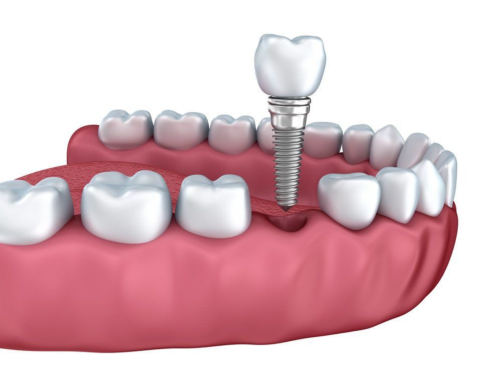 عوامل تعیین کننده در ایمپلنت دندان