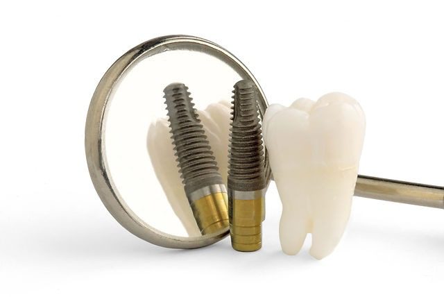 نکات مهم در قالب گیری ایمپلنت دندان