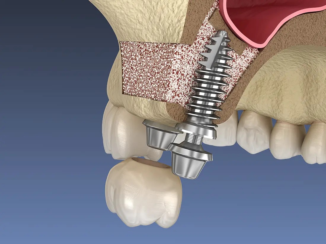 انواع ایمپلنت دندان بر اساس مکان قرارگیری در استخوان فک