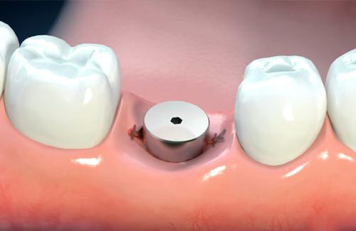 فرق هیلینگ و اباتمنت دندان چیست