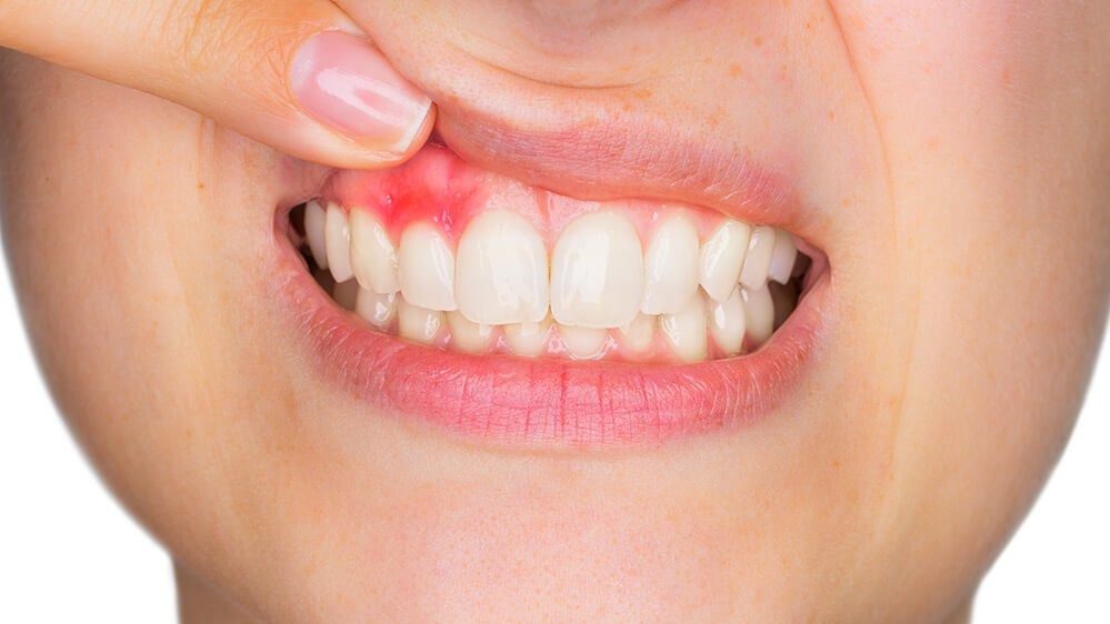 تحلیل لثه چیست و چقدر اهمیت دارد؟