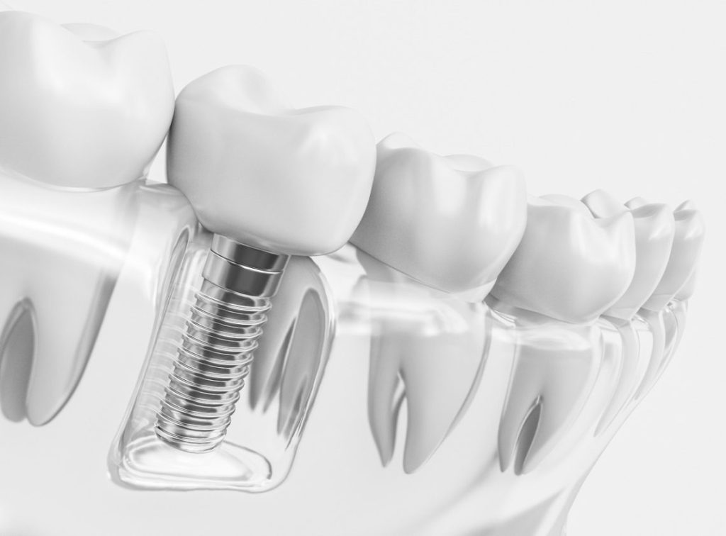 عوامل مؤثر بر قیمت ایمپلنت دندان