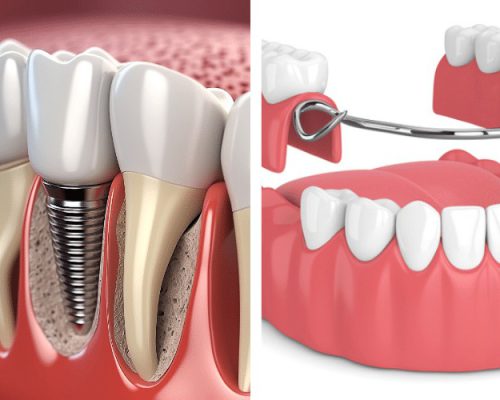 ایمپلنت بهتر است یا دندان مصنوعی