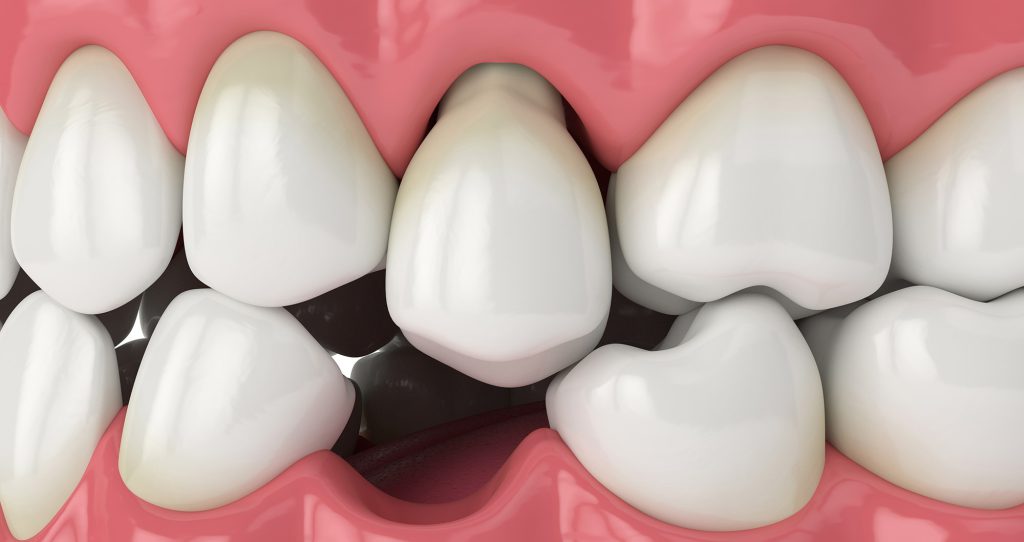 لق شدن دندان دائمی و روند ترمیم و درمان آن