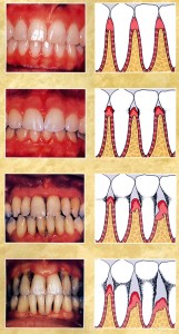 بیماری لثه و بافت های اطراف دندان