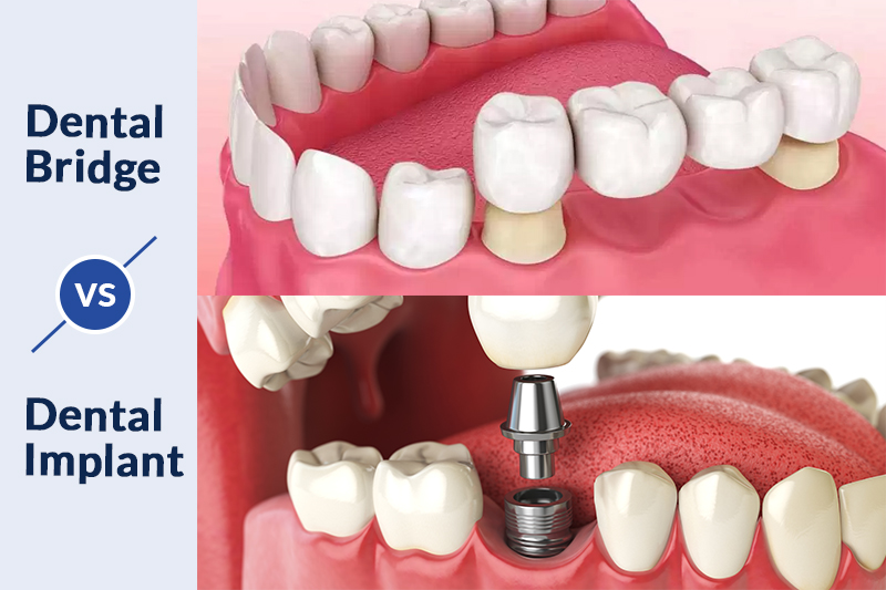 تفاوت ایمپلنت دندان  و بریج