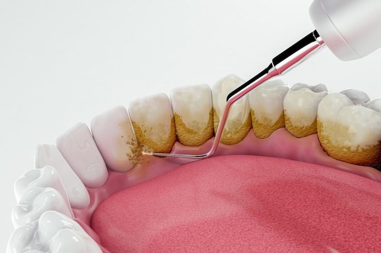 پاکسازی و جرم گیری برای لمنیت دندان