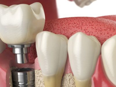مراحل قالب گیری ایمپلنت دندان
