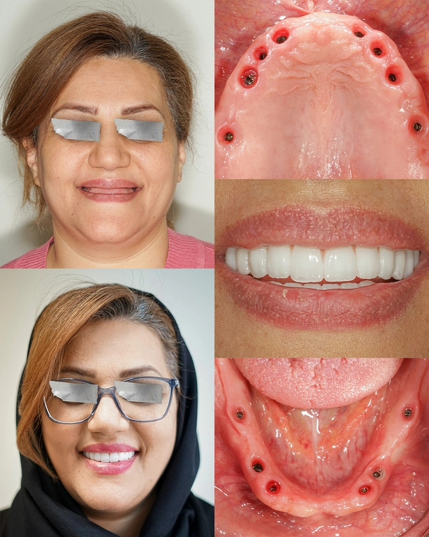 ایمپلنت فوری All-on-X چیست و برای چه کسانی مناسب است؟