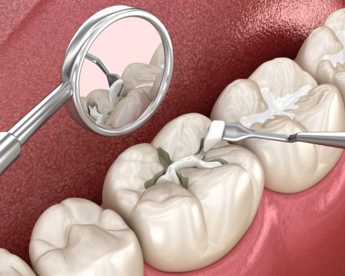 فاصله بین عصب کشی و پر کردن دندان چقدر است؟