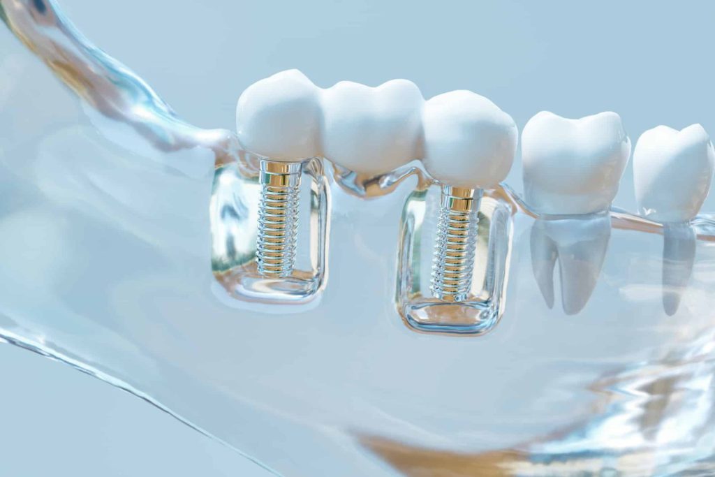 شرط دوام و ماندگاری پروتز دندان