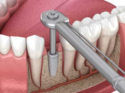 عوامل مؤثر بر زمان ایمپلنت دندان
