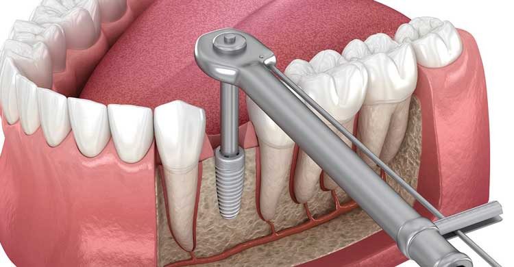 عوامل مؤثر بر زمان ایمپلنت دندان