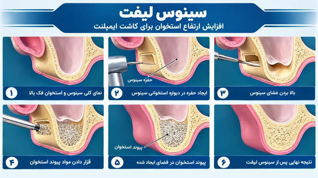 سینوس لیفت چیست