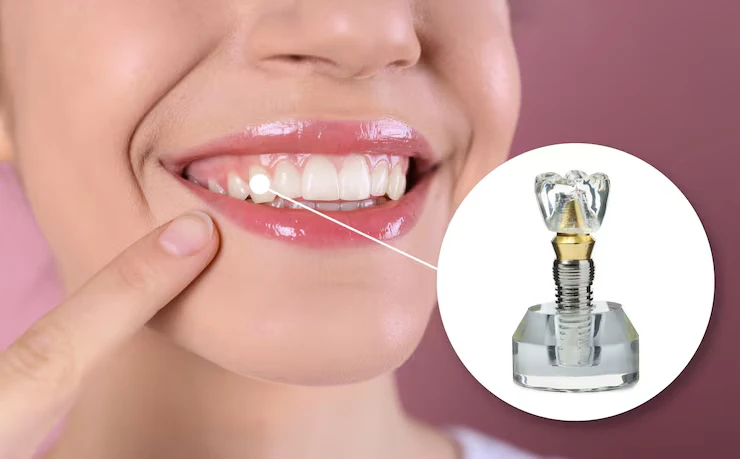 آیا برای هر ایمپلنت باید جداگانه مراجعه کرد؟