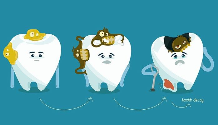 مراحل پوسیدگی دندان و پیشگیری از آن 