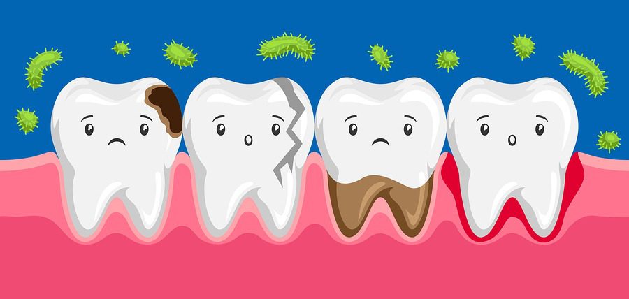 عفونت دندان چیست؟ علت و علائم