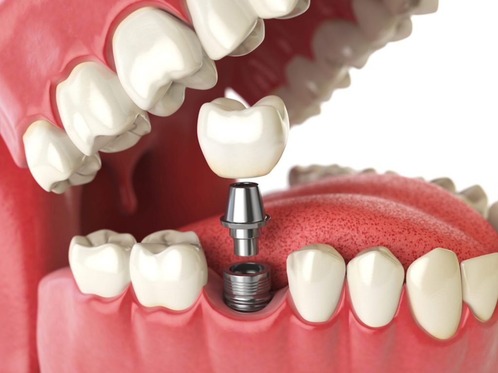 راه هایی برای کاهش هزینه ایمپلنت دندان