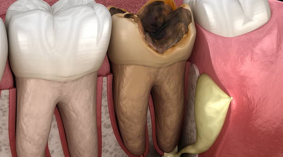 آیا عصب کشی دندان دردناک است؟