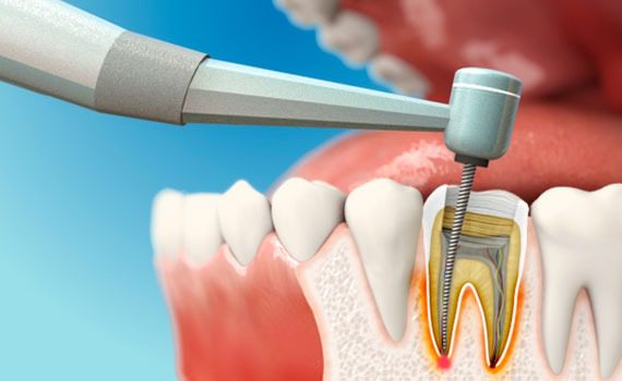 آیا هر دندان دردی عصب کشی نیاز دارد؟
