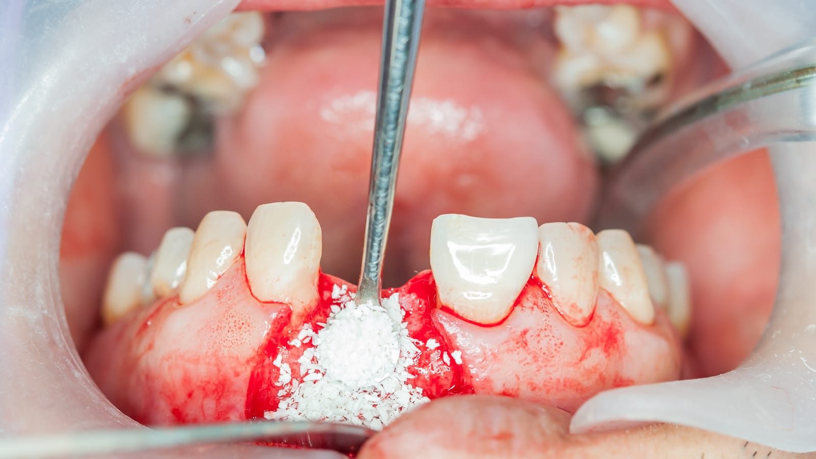 انواع پودر استخوان در ایمپلنت دندان
