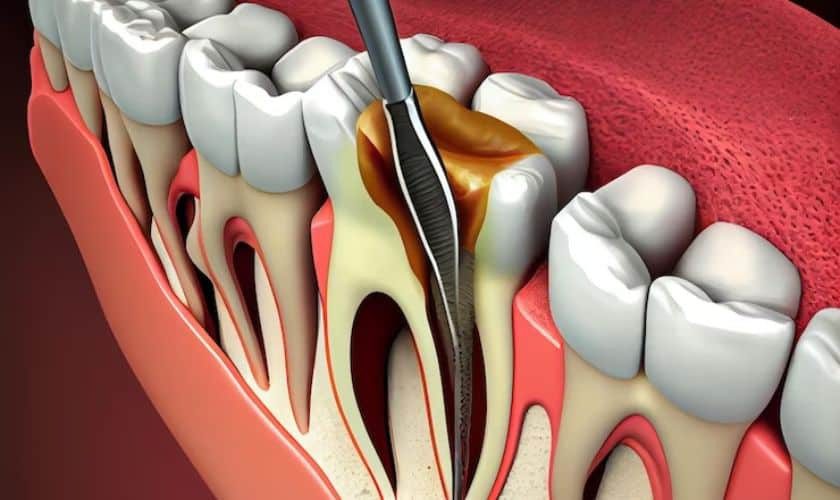 به عصب رسیدن پوسیدگی دندان چقدر طول می کشد؟