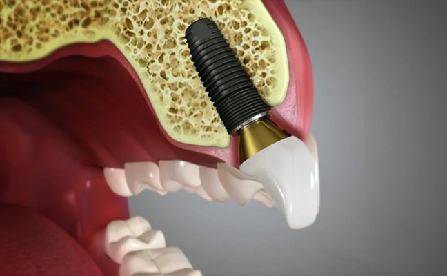 بیمه تکمیلی گروهی برای پرداخت هزینه ایمپلنت دندان
