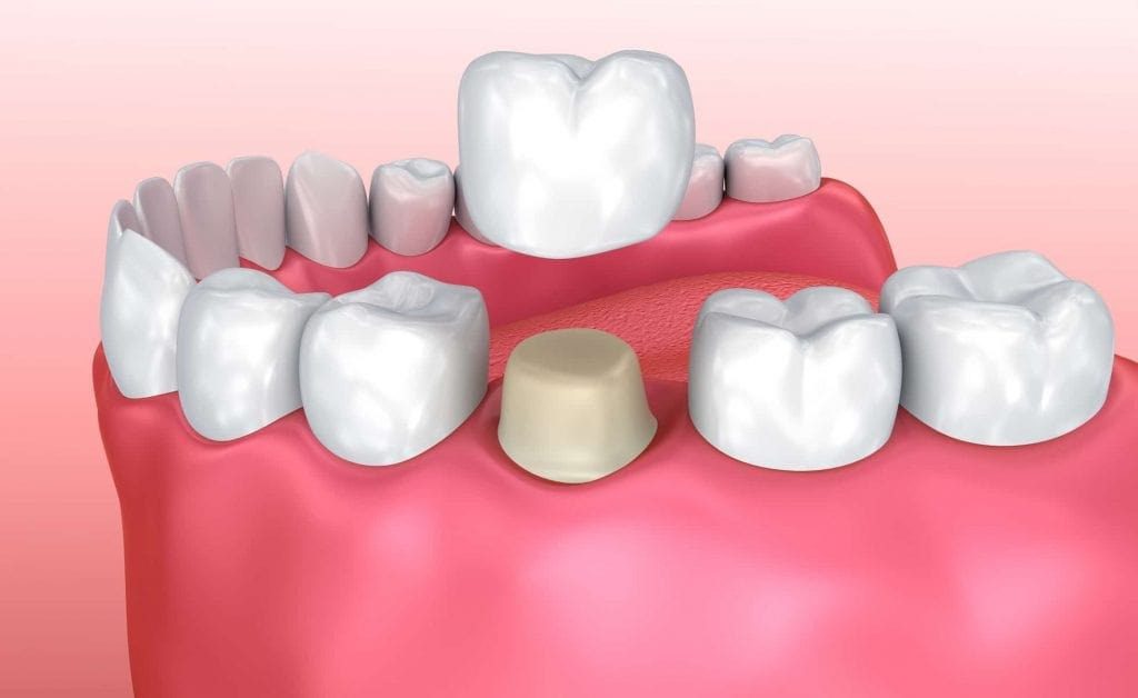 تفاوت بیلداپ و روکش دندان در چیست؟