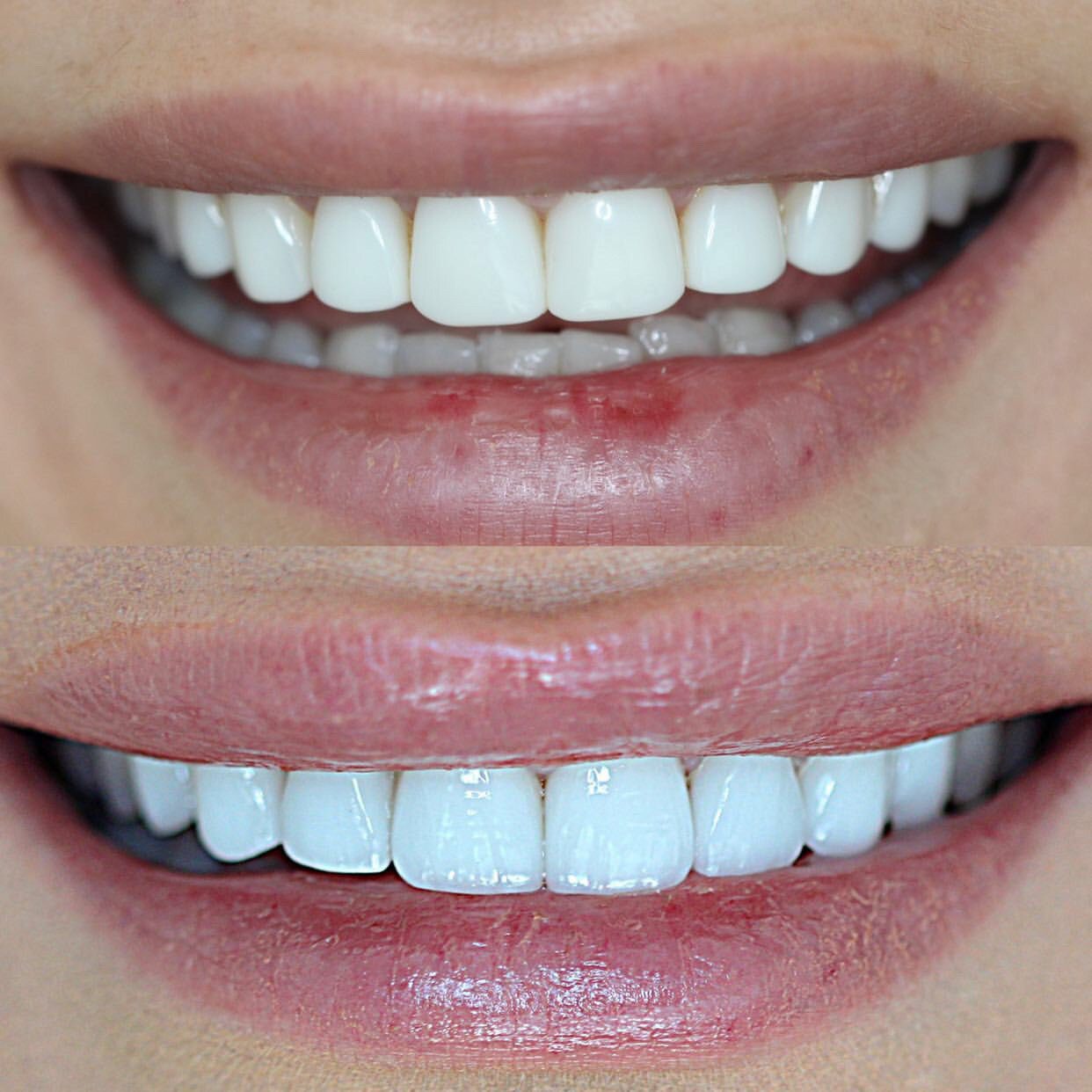 تفاوت روکش دندان و کامپوزیت از لحاظ ساختار دندانی