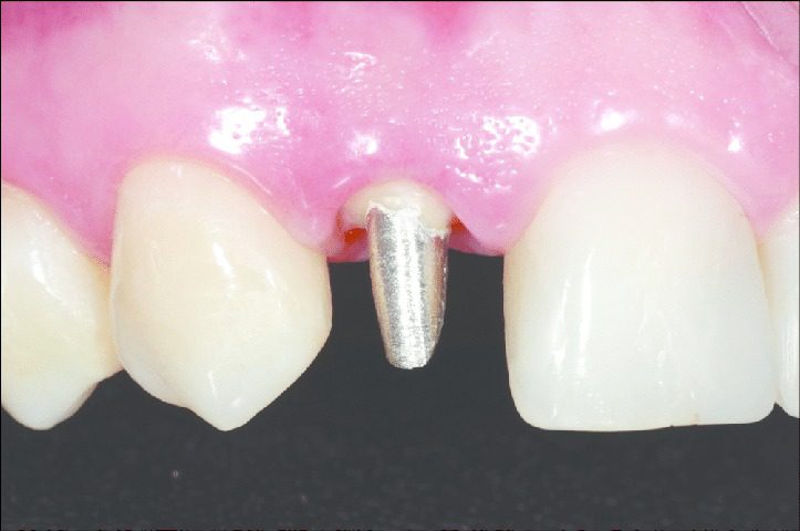 جنس پست دندان از چیست؟