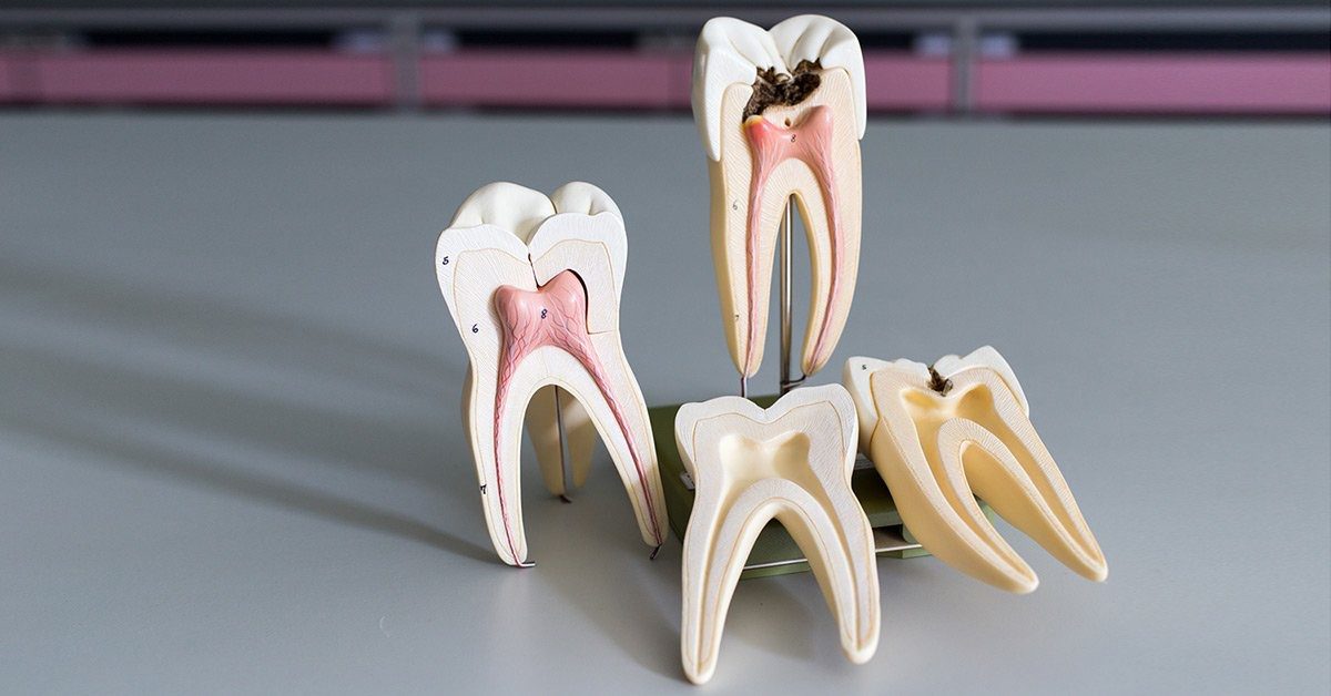 درمان لایه های ریشه دندان چگونه انجام می شود؟