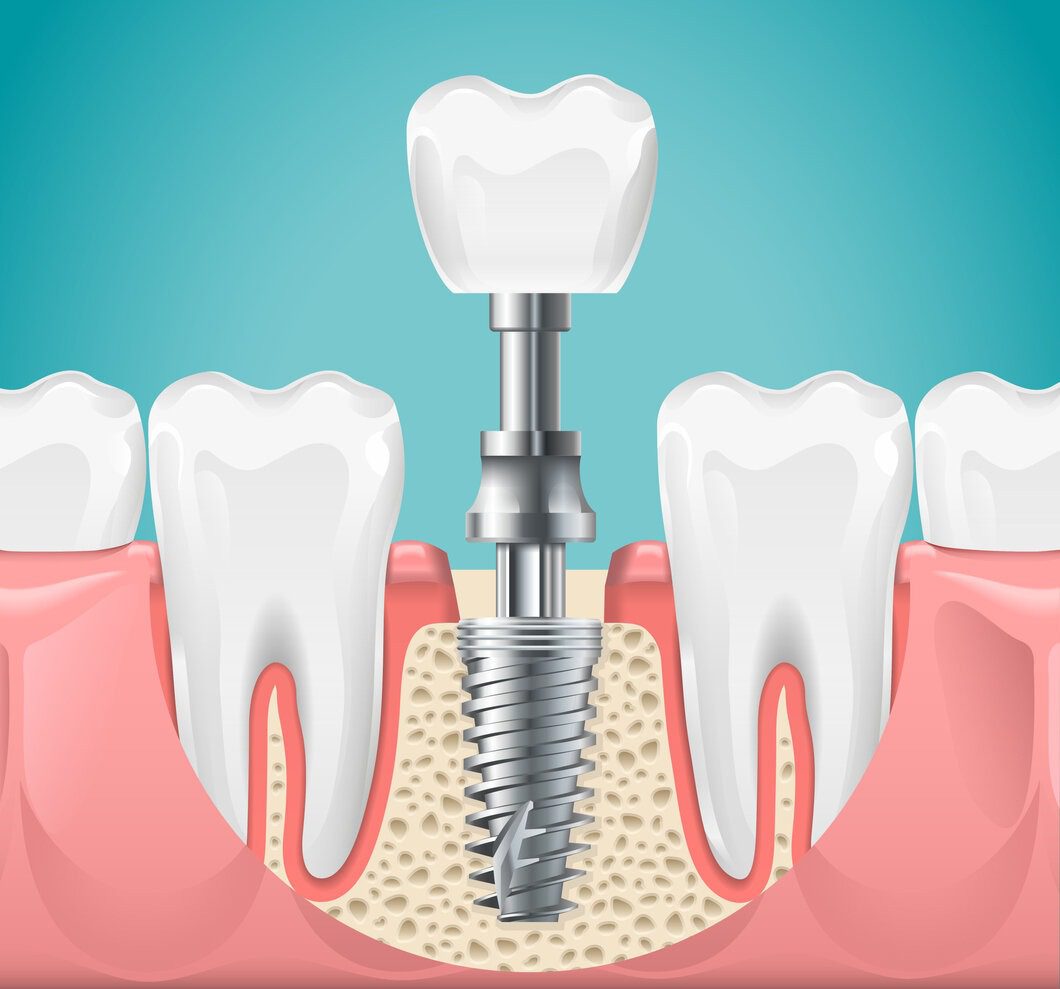 راه های جلوگیری از عفونت کردن دندان پس از ایملپنت