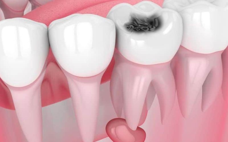 روش های خانگی درمان عفونت دندان