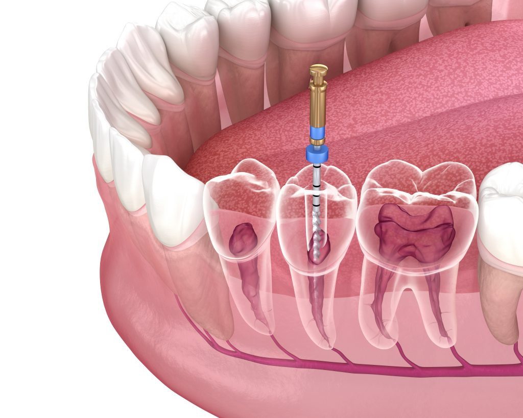 فاصله بین عصب کشی و پر کردن دندان