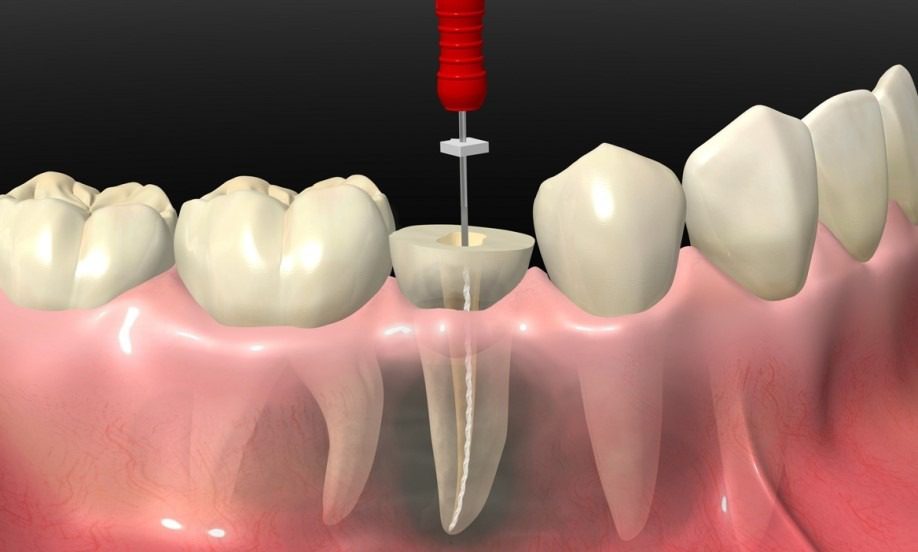 عصب کشی و پر کردن همزمان دندان