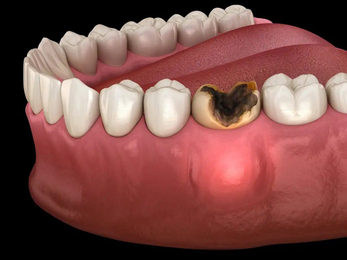 علت عفونی شدن دندان چیست؟