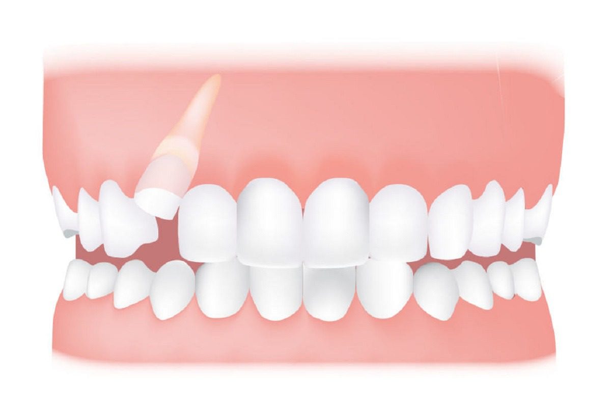 عوارض دندان نفهته چیست؟