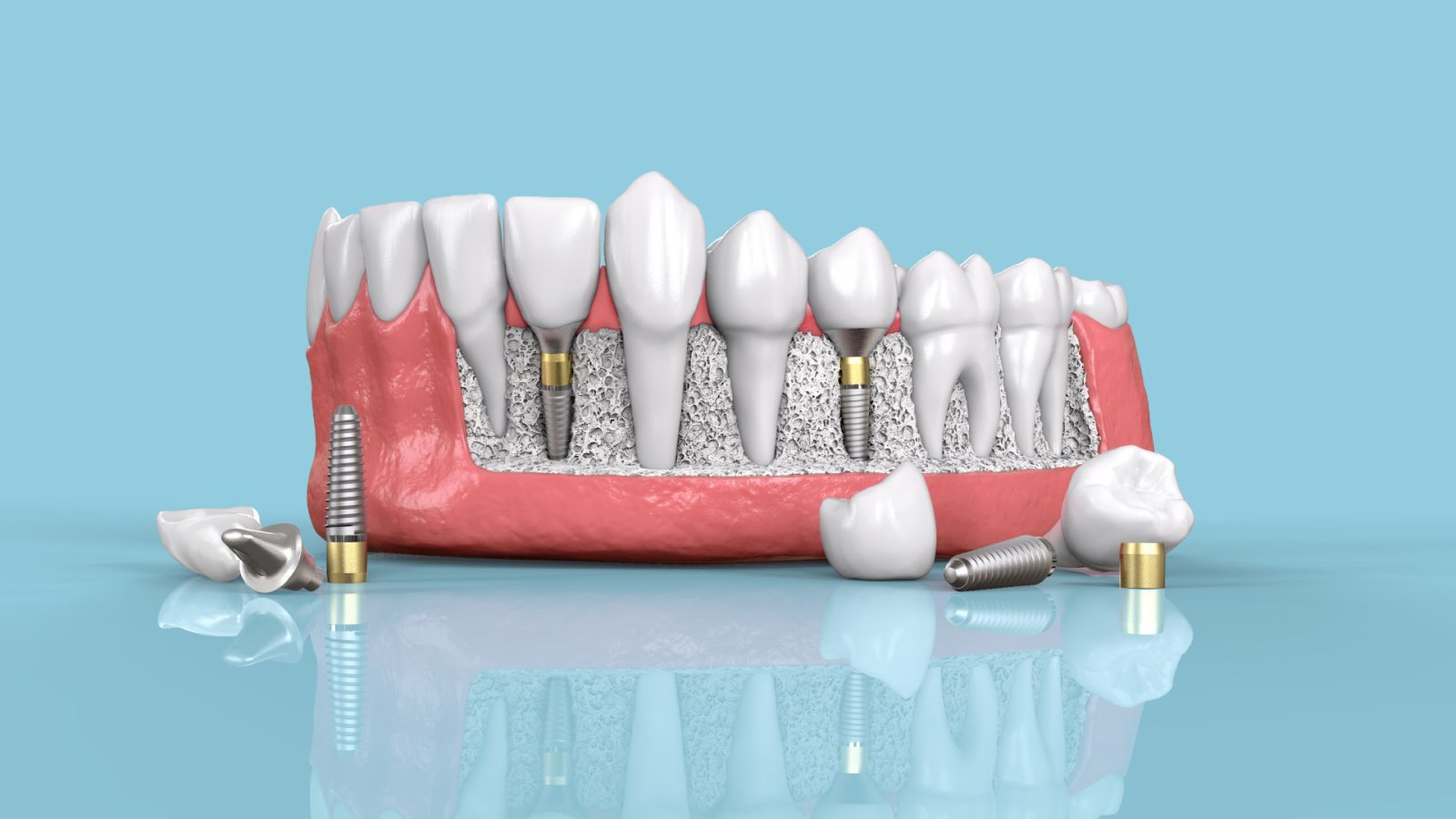 عوامل مؤثر در خرابی ایملپنت دندان پوسیده