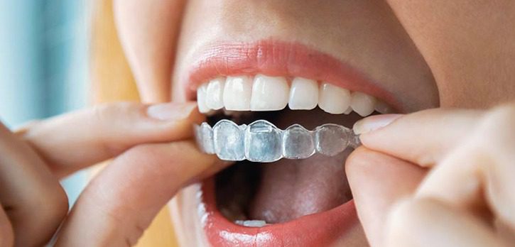 مدت زمان ارتودنسی برای دندان های با فاصله