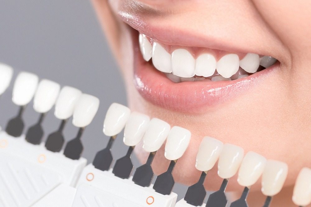 مدت زمان لازم برای بهبودی در روش کامپوزیت و روکش دندان