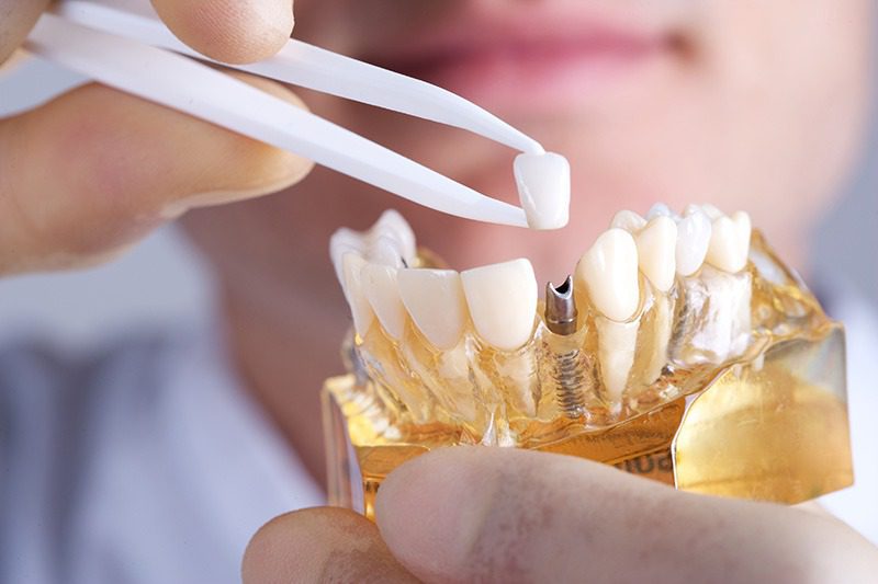 هزینه ایمپلنت دندان با بیمه های دولتی