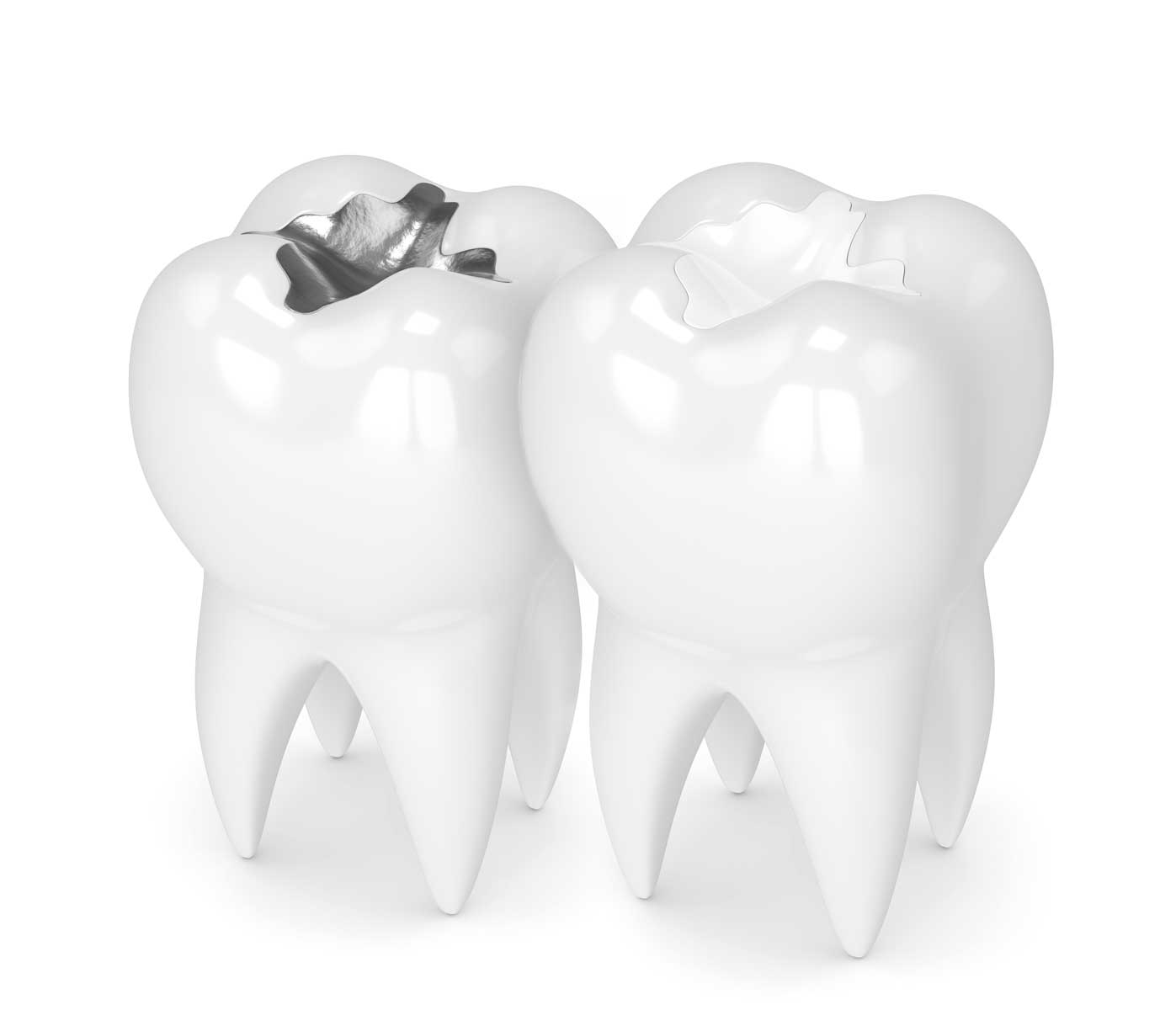 پرکردن دندان با مواد سفید یا سیاه؟ کدام بهتر است؟