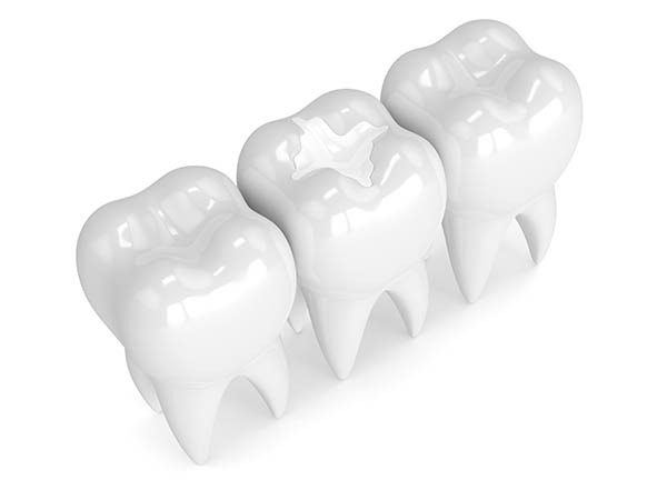 پر کردن دندان جلو با ماده سفید یا سیاه؟