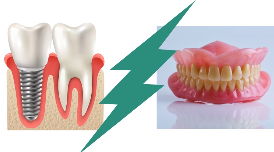 کارایی ایمپلنت بهتر است یا دندان مصنوعی؟