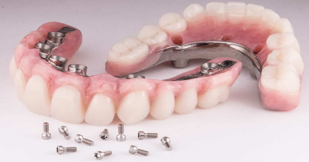 کاشت دندان مصنوعی ایملپنت برای چه کسانی مناسب است؟