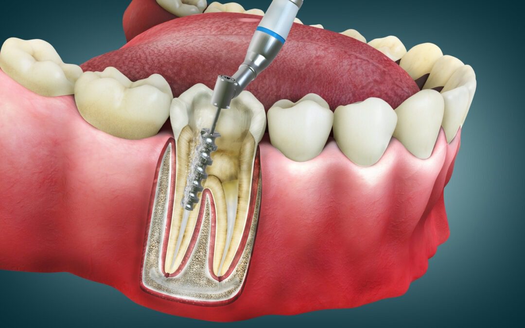 کاهش ریسک پوسیدگی دندان
